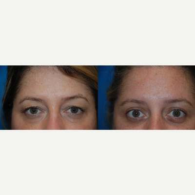 Eyelid Surgery before and after photo