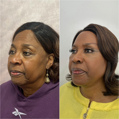 Brow Lift before and after photo