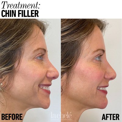 Chin Filler before and after photo
