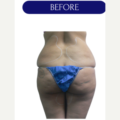 Nonsurgical Butt Lift: What You Need to Know