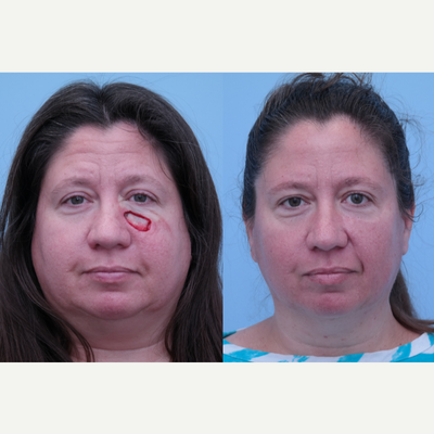 Mohs Surgery before and after photo