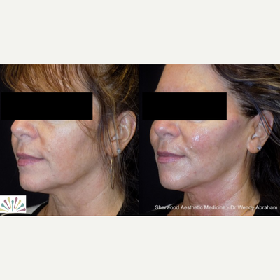 Dermal Fillers before and after photo