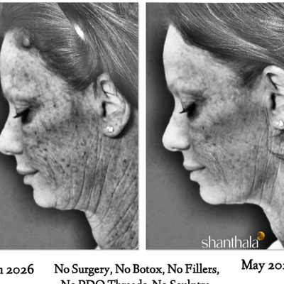 Skin Rejuvenation before and after photo