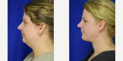 Chin Implant  - Chin Implant in New Orleans woman along with Primary Rhinoplasty and liposuction by Facial Plastic Surgery Specialist, Dr. Sean Weiss in Metairie, Louisiana