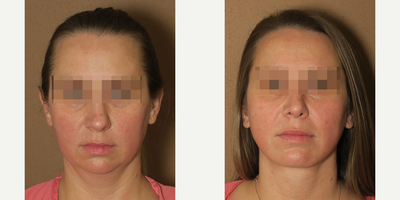 Woman treated with Rhinoplasty - Woman treated with Rhinoplasty