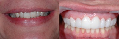 Combination Invisalign and Lumineers - 
	Patient wanted to have a prettier smile. She had some crowding and some old bonding. Her choice of treatment was to use Invisalign initially and then no prep veneers to finish her smile makeover! Great results.

