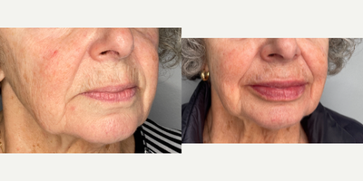 75 and up year old woman treated with Lip Fillers - patient treated with two syringes of RHA Redensity in the lips and lip lines