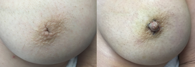 Frontal View: Inverted Nipple Surgery patient, female, day of. - Inverted Nipple Surgery patient, female, day of.