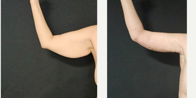 35-44 year old woman treated with Arm Lift - Arm Lift
