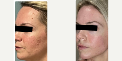 35-44 year old woman treated with Opus Plasma - This client struggles with Rosacea. She also wanted to target any visible signs of aging. The results shown are after completing 2 Opus treatments 4 weeks apart each.