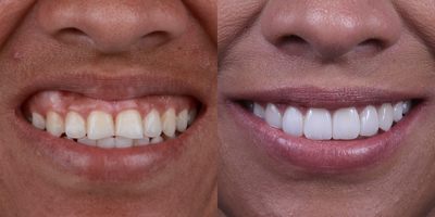 25-34 year old woman treated with Tooth Repair - We corrected the gummy smile and improved the color and shape of the teeth with porcelain veneers.