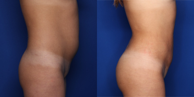 25-34 year old woman treated with Liposuction, Brazilian Butt Lift - 25 year old female shown 6 weeks after lipo 360 as well as fat transfer to her buttocks. She had 2.5 L fat removed and 650 cc of fat placed to each buttock.