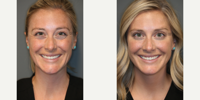 Xeomin - Treatment of forehead, brows, eyes.
