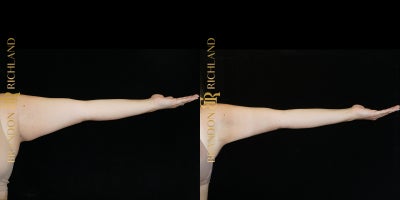 25-34 year old woman treated with Liposuction, Renuvion - Liposuction and Renuvion for beautifully sculpted arms! Our patient, in her 30s, is thrilled with the smooth, toned results, achieving a more defined and youthful appearance. She feels confident and empowered with her refreshed look!