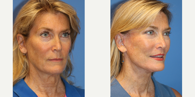 55-64 year old woman treated with Facelift, Laser Genesis, Lip Lift - This is a 62 year old female otherwise healthy with signs of facial ageing including elongation of the upper lip, skin laxity of the face and neck causing jowling, loss of the cervicomental (chin/neck) angle, platysma banding, soft tissue descent of the midface, nasolabial folds. The patient underwent deep plane facelift, lip lift. Photos are before and 5 months post op. The patient underwent post op facelift protocol including lymphatic massage, laser genesis and scar cream application to enhance/ accelerate her healing process.