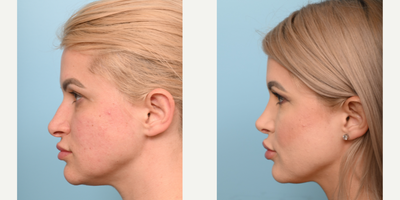 18-24 year old woman treated with Rhinoplasty - Our patient was kind enough to share her recovery results after having a Rhinoplasty 3 months ago! Over the next year her nose will become more refined!
