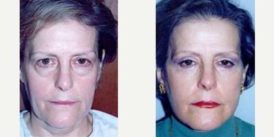 55 year old woman treated with Laser Resurfacing - 55 year old woman treated with Eyelid Surgery and Laser Resurfacing