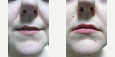 Woman treated with Lip Lift - Woman treated with Lip Lift