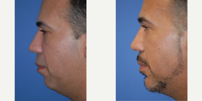 Man treated with Smart Lipo - Man treated with neck Smart Lipo