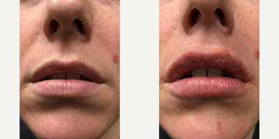 Woman treated with Lip Lift - Woman treated with Lip Lift