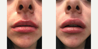 Woman treated with Lip Lift - Woman treated with Lip Lift