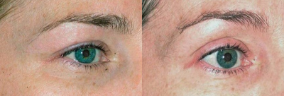45-54 year old woman treated with Thermage - 1 month after Thermage eyes