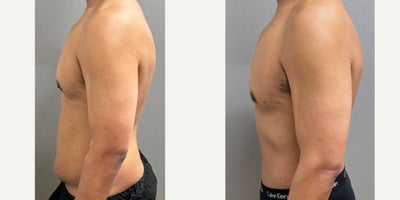 35-44 year old man treated with Male Tummy Tuck - 38 year old male s/p tummy tuck performed in our on site AAAA certified operating suite.