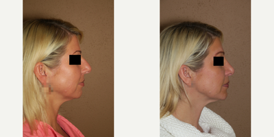35-44 year old woman treated with Rhinoplasty - 1 year post rhinoplasty