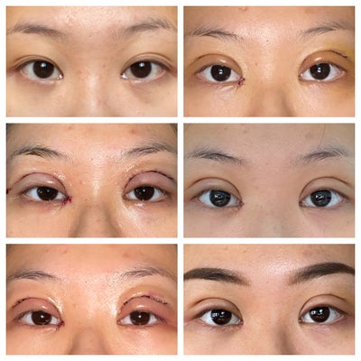 double eyelid surgery new york