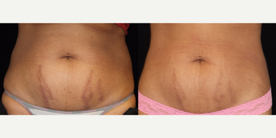 25-34 year old woman treated with SculpSure - This patient always had trouble losing weight in her abdomen, she was thin overall but could not get rid of her stomach pooch. She had 2 treatments of SculpSure to both her abdomen and flanks done 6 weeks apart. She followed Dr. Anton's 12 week diet and lifestyle shift program during this treatment period and also lost weight on her own. She also had a Fractora radio frequency treatment to help lighten her stretch marks.