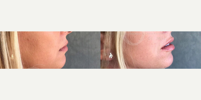 Woman treated with Injectable Fillers - Woman treated with Injectable Fillers to lips