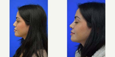 25-34 year old woman treated with Nonsurgical Nose Job - Restylane was used to augment this patient's nose.