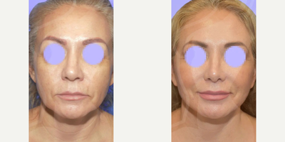 Woman treated with Facelift - Her smile without a doubt reflects the satisfaction and happiness obtained with the results of her procedure.Procedure: Complete Ritidectomy