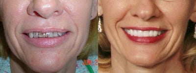 Porcelain Veneers  - This patient had more than 20 veneers (and crowns) placed by Dr. Sarah Thompson in a single appointment. &nbsp;She used our in-office financing to help offset the cost. We guarantee our veneers and crowns for 10 years.