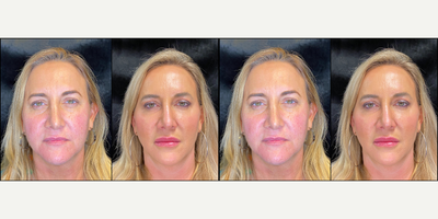 45-54 year old woman treated with Dermal Fillers, Dysport, Facial - We went on a journey together to improve her facial structure with dermal fillers, Dysport and a facial. First we did Dysport in the upper face to smoothe lines and wrinkles. We then placed 2 Juvederm Voluma midface (lateral cheeks) to restore the youthful G-curve and lift her lateral face. 1 syringe of Juvederm Volbella was placed to the tear trough to brighten and cast shadows out of that under eye area and 2 syringes of Juvederm Ultra Plus were placed to her lips. She looks so refreshed!