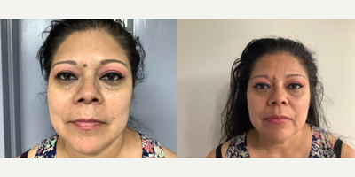 45-54 year old woman treated with Dermal Fillers, Lip Fillers, Cheek Fillers, RHA Collection Fillers - Did half a syringe of 4 rha on each cheek for total of 1 syringe total on both cheeks and lip only rha 2 for a total of 1 RHA 2 syringe