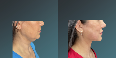 35-44 year old woman treated with Thermage FLX - 35-44 year old woman treated with Thermage FLX