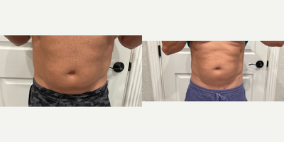 45-54 year old man treated with Microneedling RF - Treatment to abdomen with the VirtueRF. DeepRF handpiece was used. 1st treatment was 7/11/22, #2 8/8/22, #3 9/12/22 the after photos were taken 10/10/22