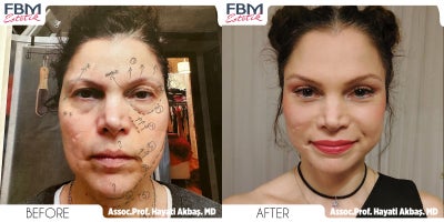 35-44 year old woman treated with Deep Plane Facelift, Eyelid Surgery, Brow Lift, Mini Facelift, Facial Fat Transfer - 35-44 year old woman treated with Deep Plane Facelift, Eyelid Surgery, Brow Lift, Mini Facelift, Facial Fat Transfer