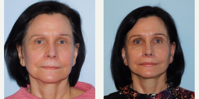 Woman treated with Mini Facelift - Before and after mini-facelift. Post-op photos were taken at 3 months.