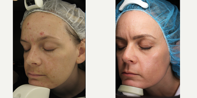 45-54 year old woman treated with Pearl Laser - 45-54 year old woman treated with Pearl Laser
