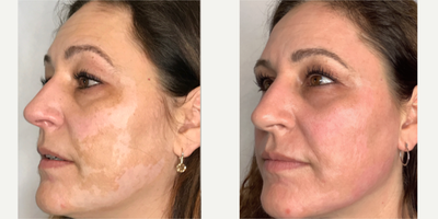 35-44 year old woman treated with Pearl Laser - 35-44 year old treated with Pearl Laser