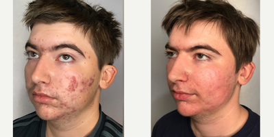 18-24 year old man treated with Pearl Laser - 18-24 year old man treated with Pearl Laser
