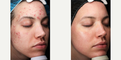 25-34 year old woman treated with Pearl Laser - 25-34 year old woman treated with Pearl Laser