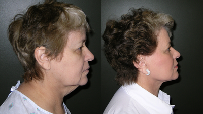 Facelift - Patient presented complaining of looking old with excess skin on face and neck.  A facelift was performed by Dr. Morea.