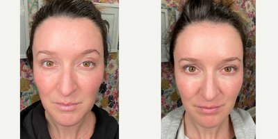 25-34 year old woman treated with Facial - My friend @the_aesthetic_anesthetist is a talented provider from Michigan who trains other aesthetic providers using EMER SKIN along with office treatments and at home protocols. Over the 2 weeks she noticed that her redness dramatically improved and was able to see a significant increase in skin quality. She loved the experience ands the results so much - that she is carrying @emer.skin at her practice in Michigan @beautiphiyou