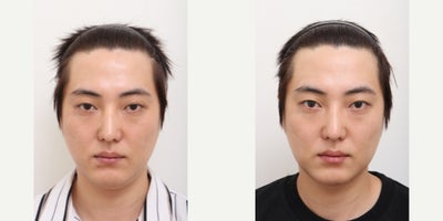 25-34 year old man treated with AccuLift, Laser Liposuction - 29 Years old male patient Chief Complain: double chinTreatment Plan:   double chin liposuction and chin muscle liftOutcome:  - double chin liposuction pure fat : 25cc- lifted jaw line reached by chin muscle lift