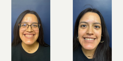 Woman treated with Botox for Gummy Smile - Woman treated with 5 units of Botox for Gummy Smile