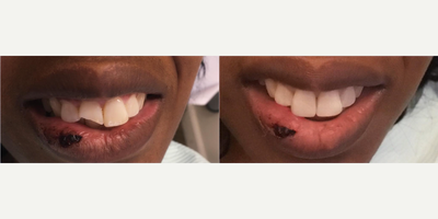 Person treated with Dental Bonding - Our Patient slipped and fell #DRV was able to fix this with some quick composite bonding.