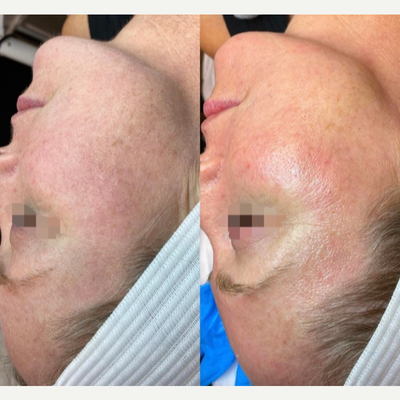 35-44 year old woman treated with Dermaplaning - Dermaplaning before and after